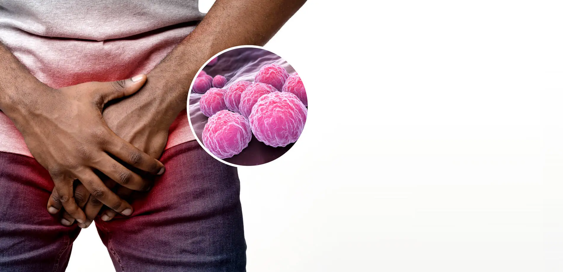 Chlamydia
