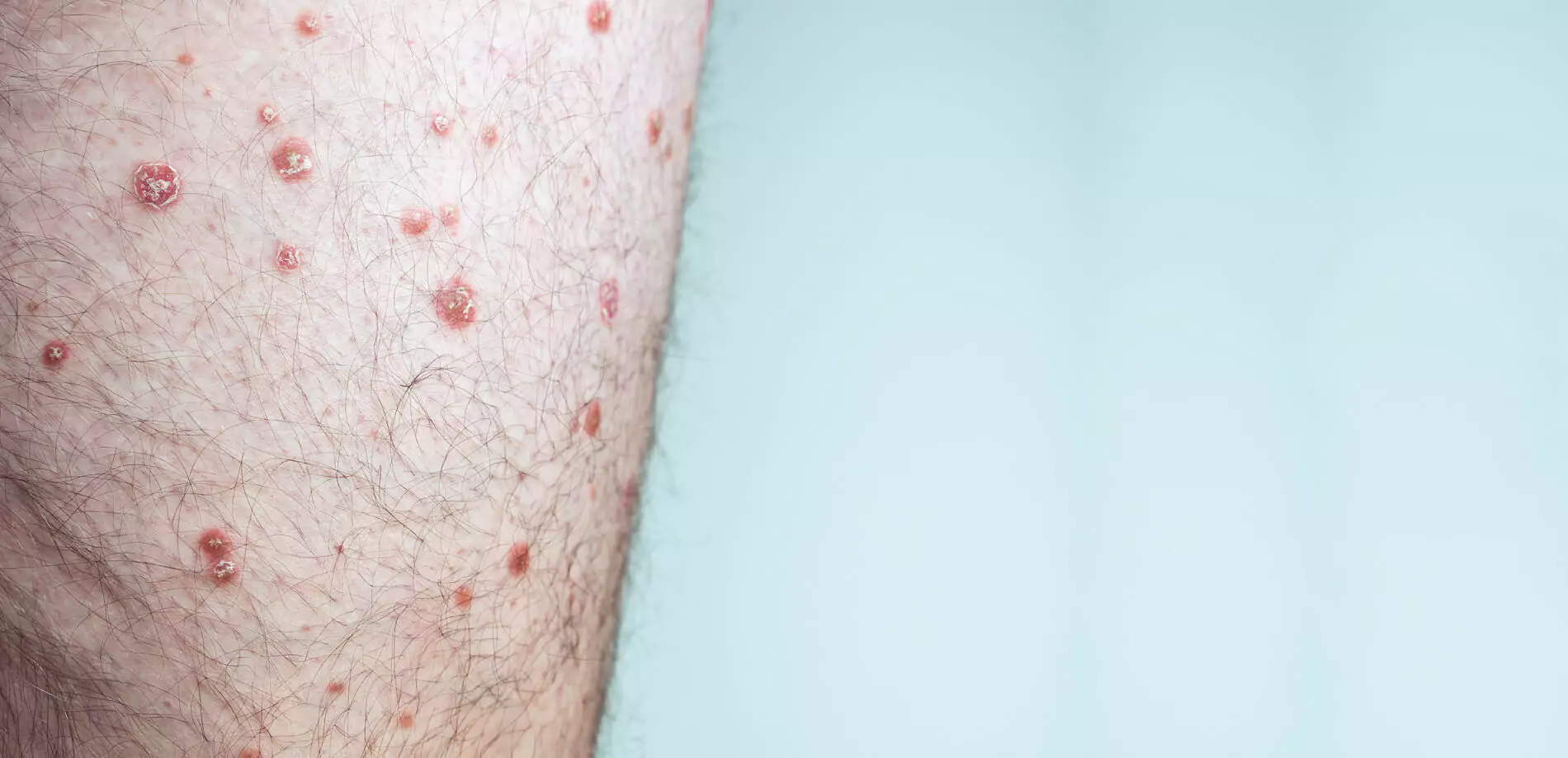 Genital Herpes