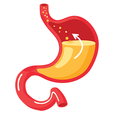 Acid Reflux
