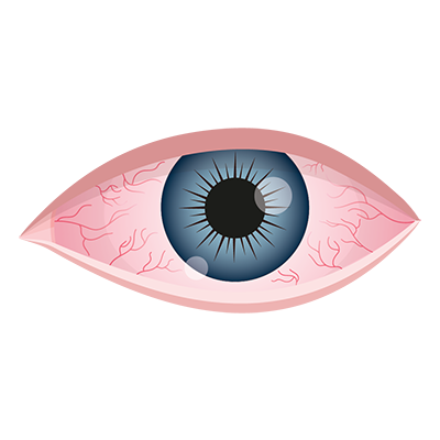 Dry Eye