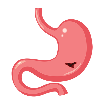 Ulcers