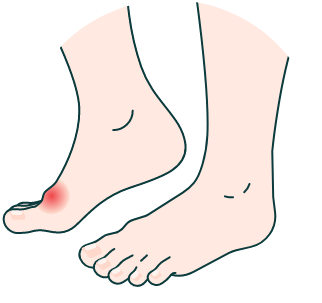 Gout