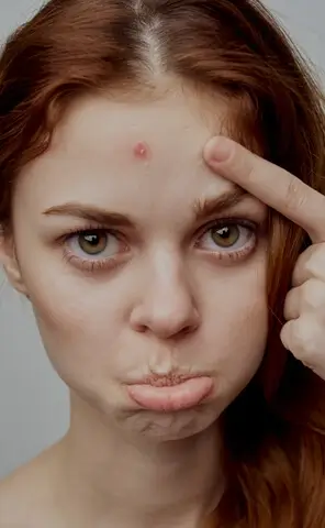 acne rosacea